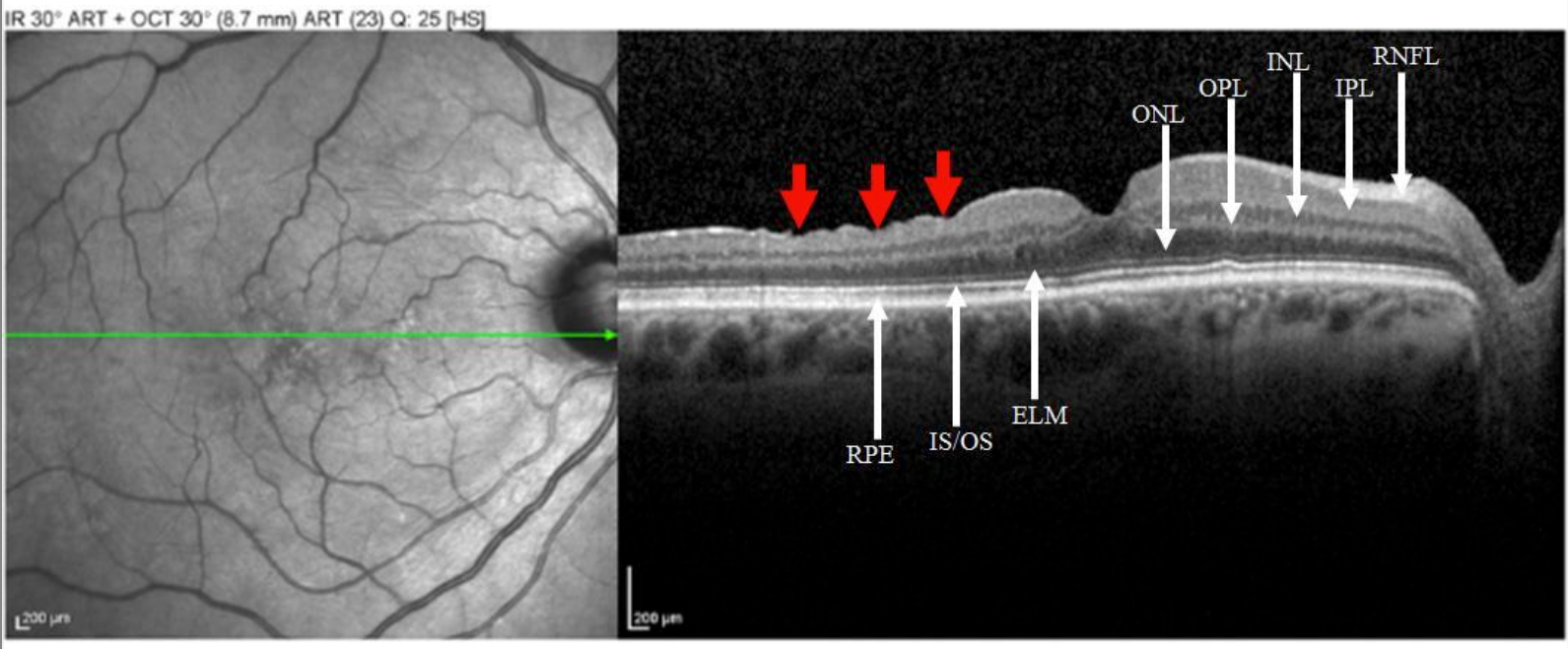SD-OCT repaired macular hole