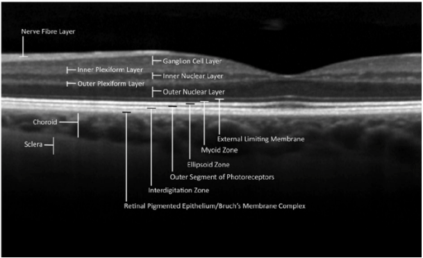 OCT myelinated retinal nerve