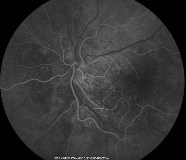 Familial Retinal Artery Tortuosity