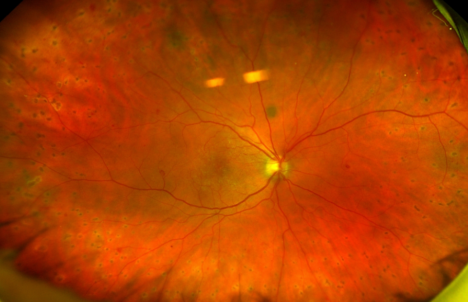 Fundus OD 2-month follow-up