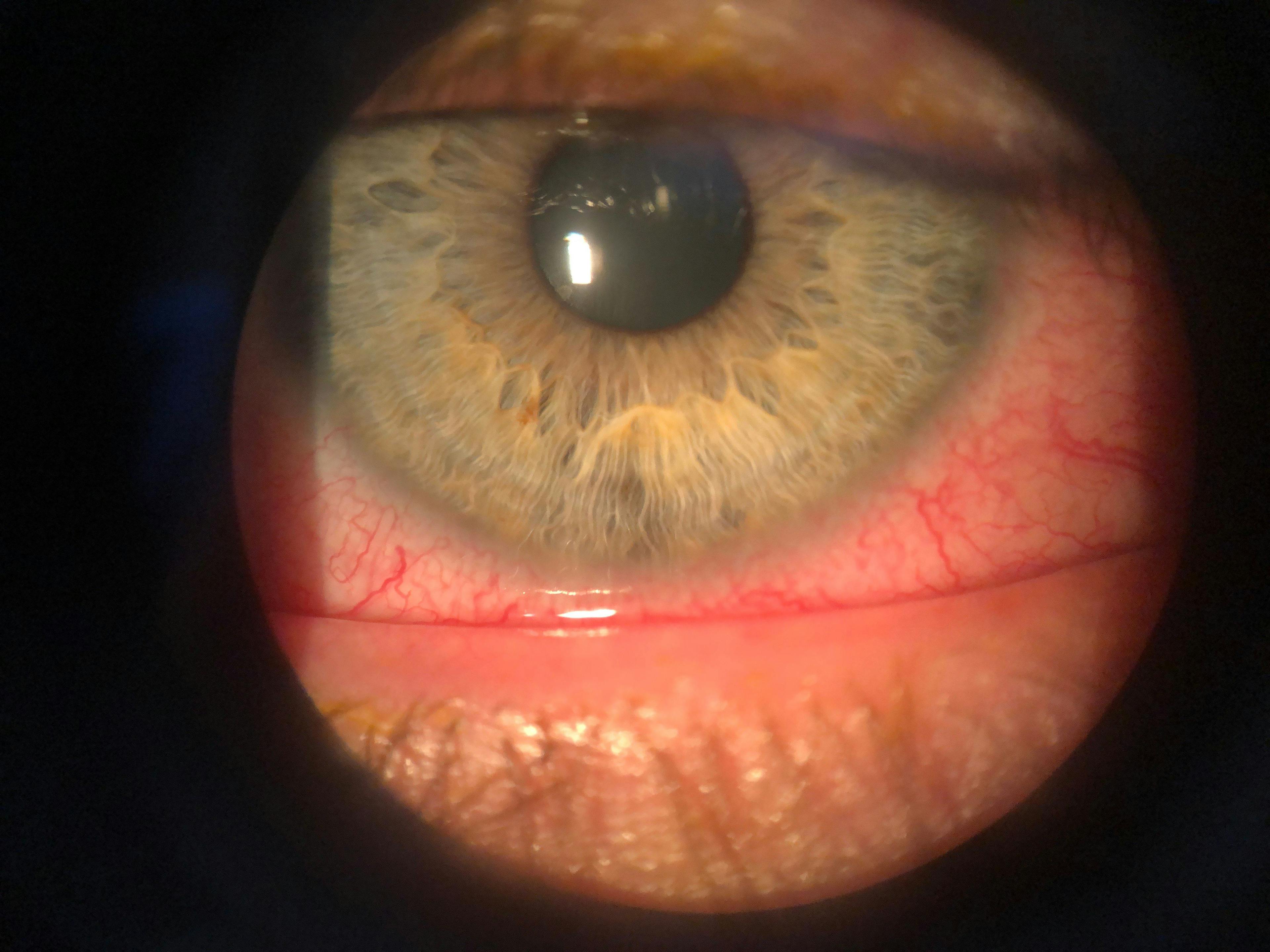 Conjunctivitis with Hyperemia Front