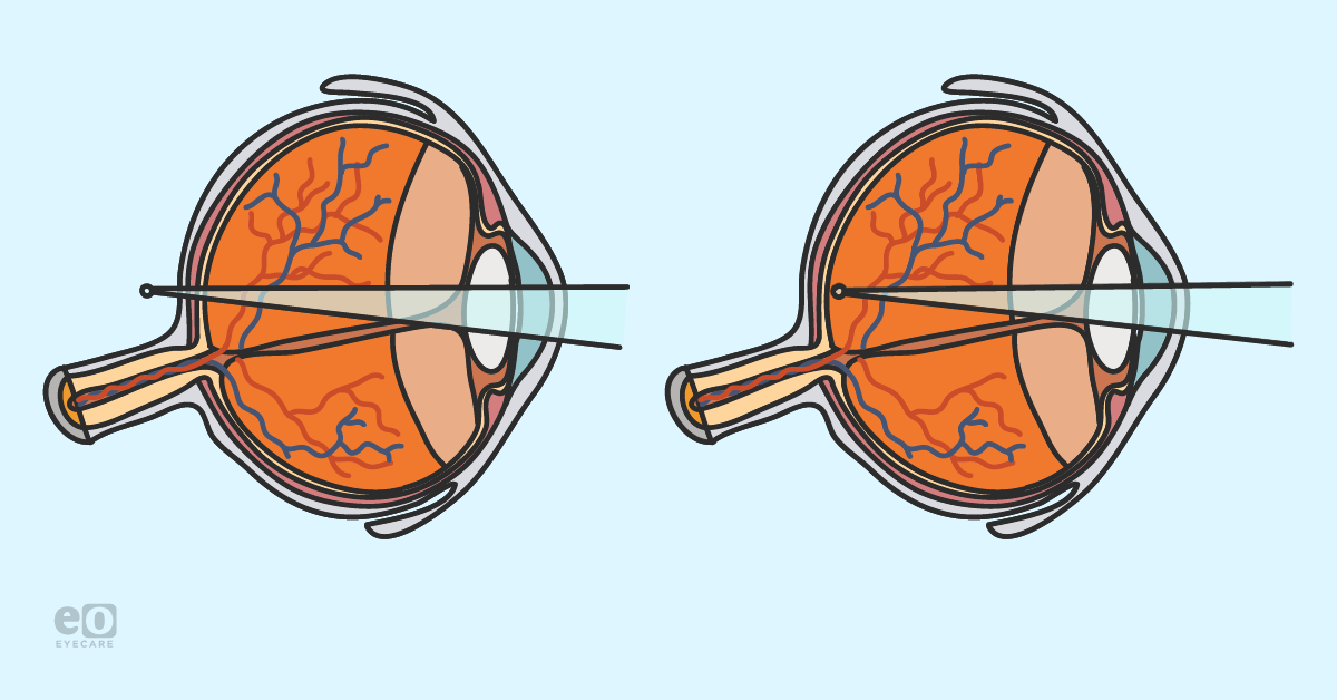Prescribing for Hyperopia: Quick Tips for New Optometrists