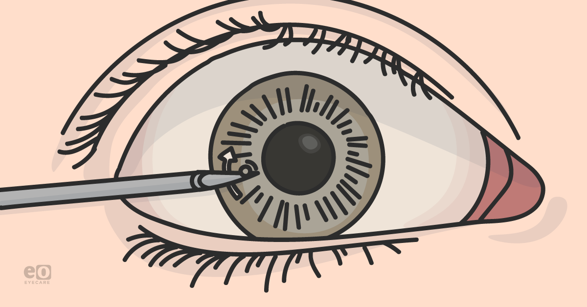 5 Procedures Every Ophthalmology Resident Must Know