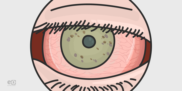 Treating Ocular Surface Disease with Amniotic Membranes