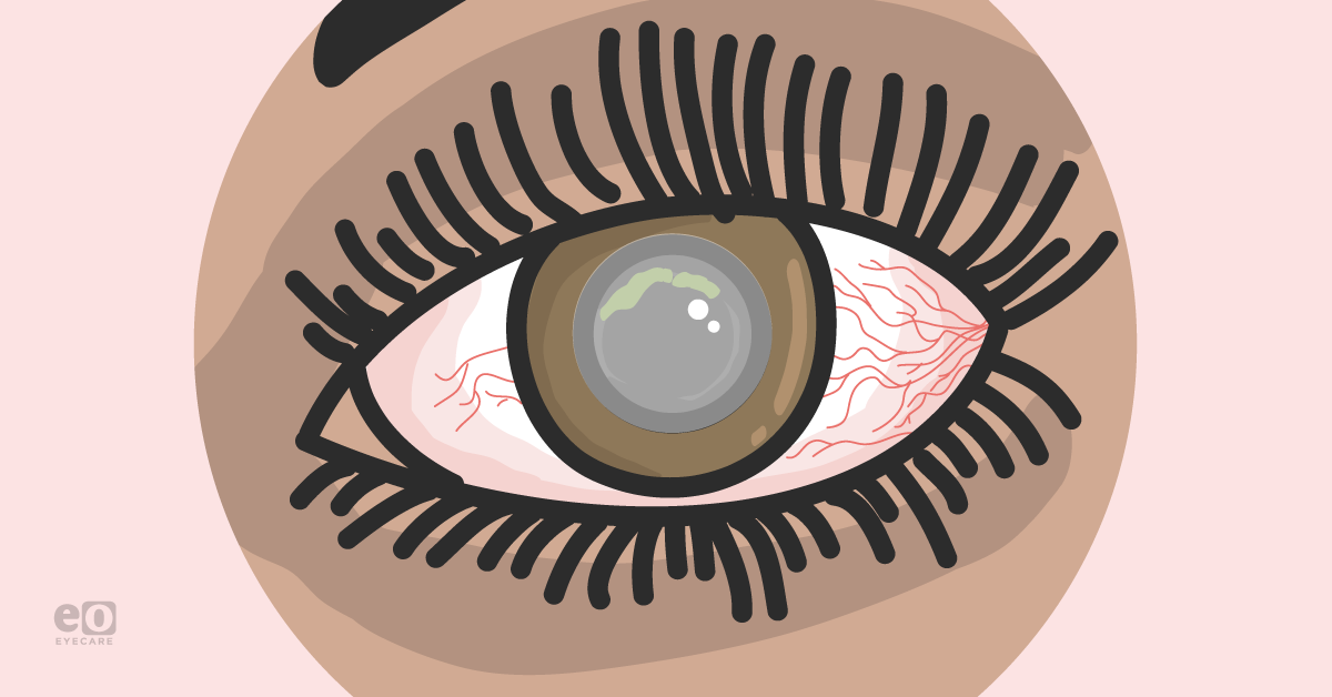 Managing Acanthamoeba Keratitis as an Ophthalmology Resident
