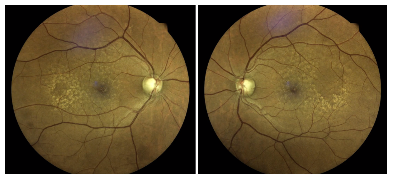 Fundus photography shows large disc size with suspiciously thin rim tissue for each optic nerve head.