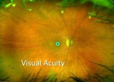 Visual acuity measures function in a small area of the retina.