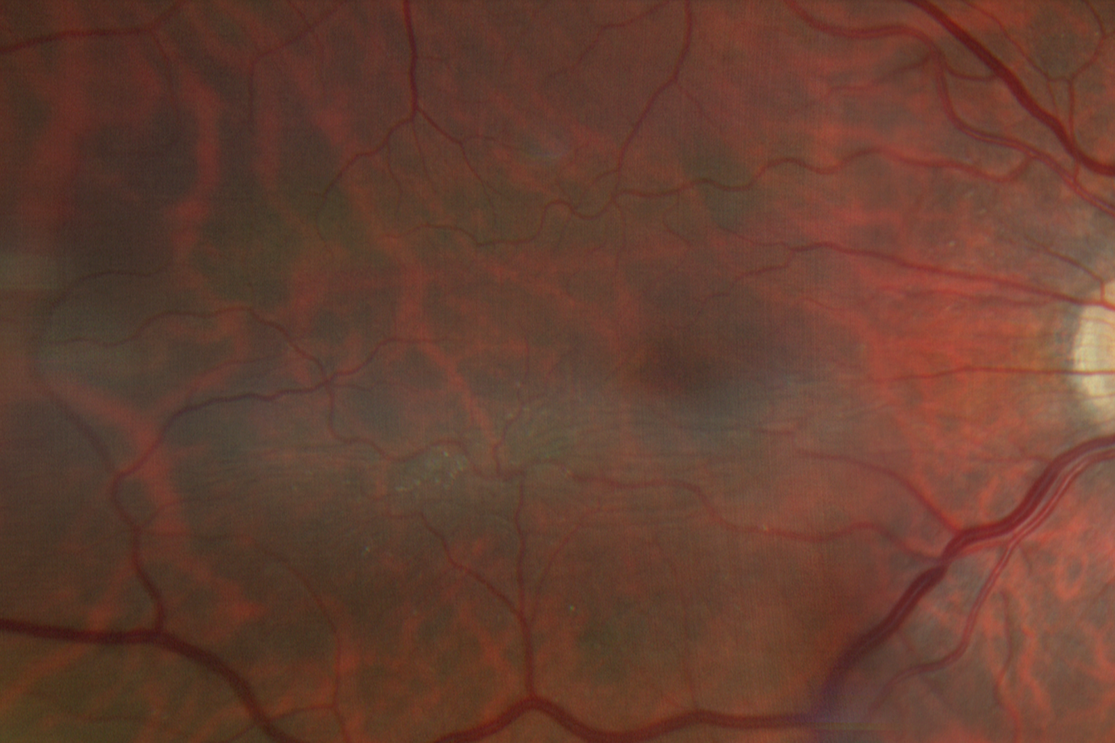 Upon zooming in on the patient’s macula in the right eye an epiretinal membrane/ macular pucker is seen.