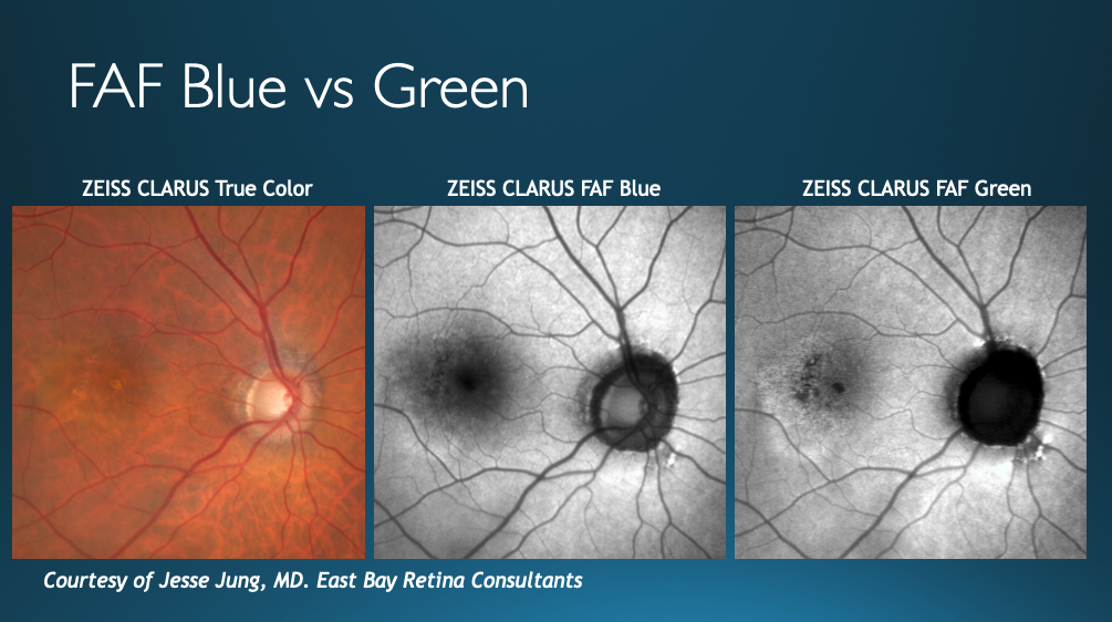 Figure 3: Comparison of a patient’s fundus captured with three different lights (broad spectrum for true color on left FAF blue in center and FAF green on right). With FAF Green foveal details are much more prominent.