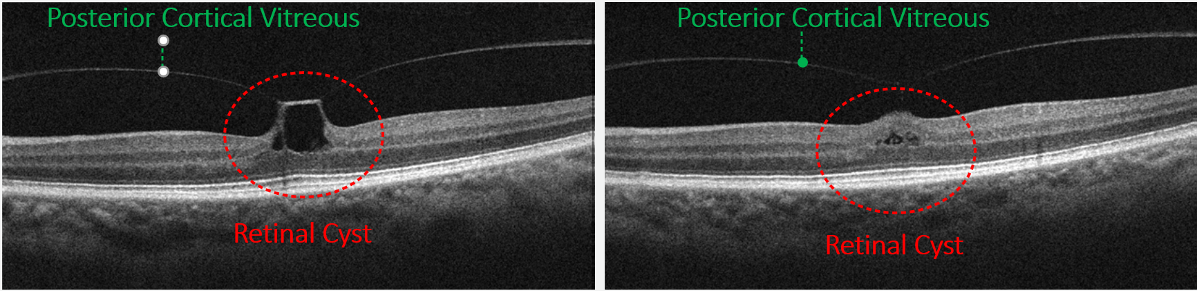 Here a case of VMT has been imaged with a raster scan allowing multiple views of the entire affected area.  Anterior to the RPE retinal cysts may develop secondary to the traction.  Vitreomacular traction can resolve spontaneously without intervention and in such cases any remaining cysts may be observed for resolution