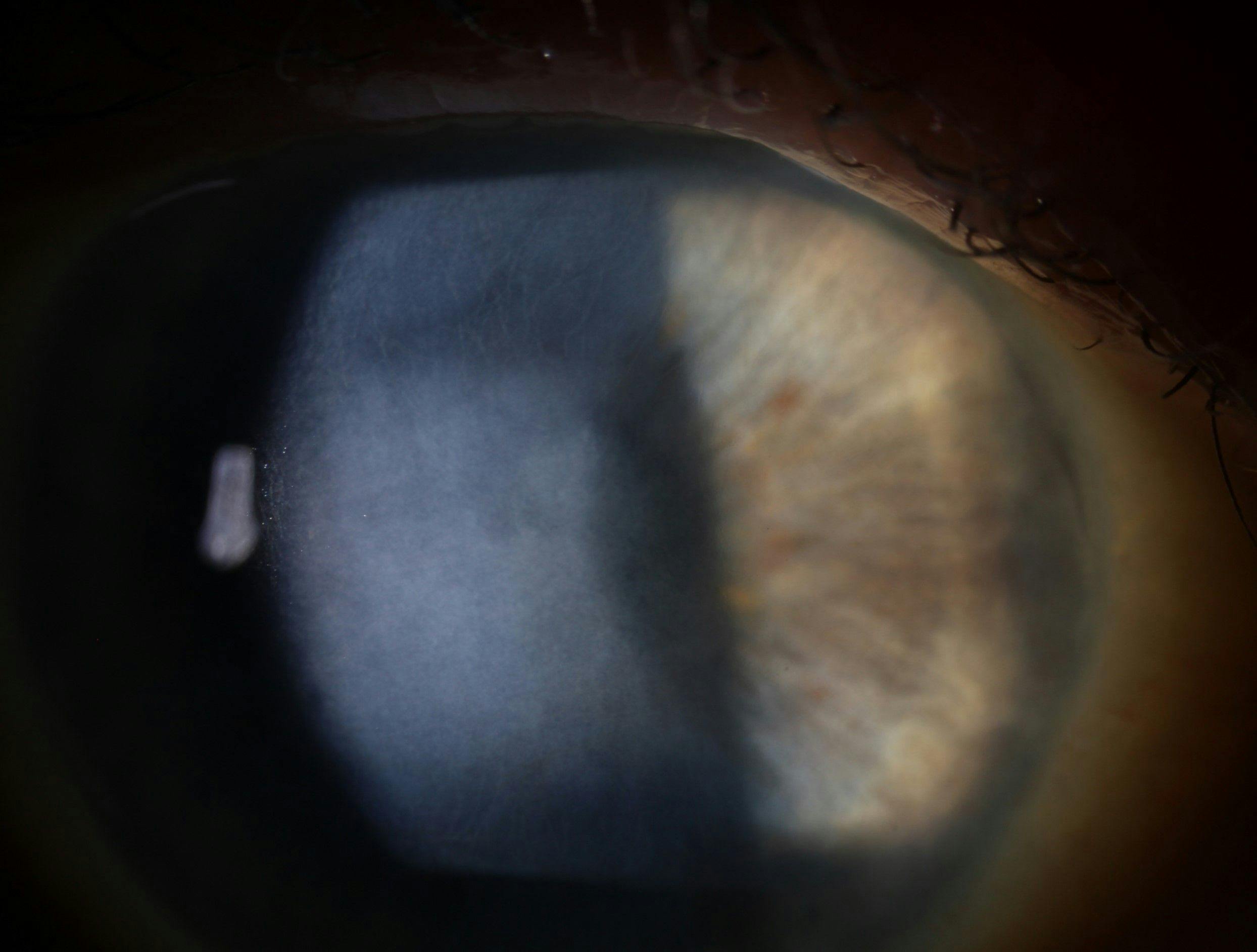 Stromal scarring ocular syphilis