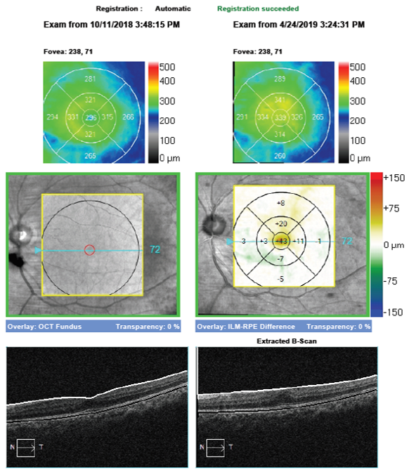 8 OCThe Zeiss Cirrus OCT is capable of providing a progression or change analysis map to highlight changes in the OCT over time.  Central thickening can be seen where the ERM is growing and causing increased traction on the retina.  In such cases retinal consult and surgical intervention may be warranted to minimize vision loss.  If a progression map is available it is important to ensure the scans are registered meaning they can be accurately compared from point to point.  This allows easy detection of increased or decreased retinal thickening which can help guide management decisionsT retinal bootcamp.png