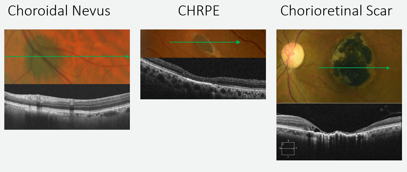 On the left choroidal thinning can be seen anterior to a flat nevus both of which are posterior to the RPE. The middle image shows outer retinal thinning with an underlying thickened RPE representing  a CHRPE.  In the image on the right a chorioretinal scar has caused significant inner and outer retinal atrophy and a distorted RPE