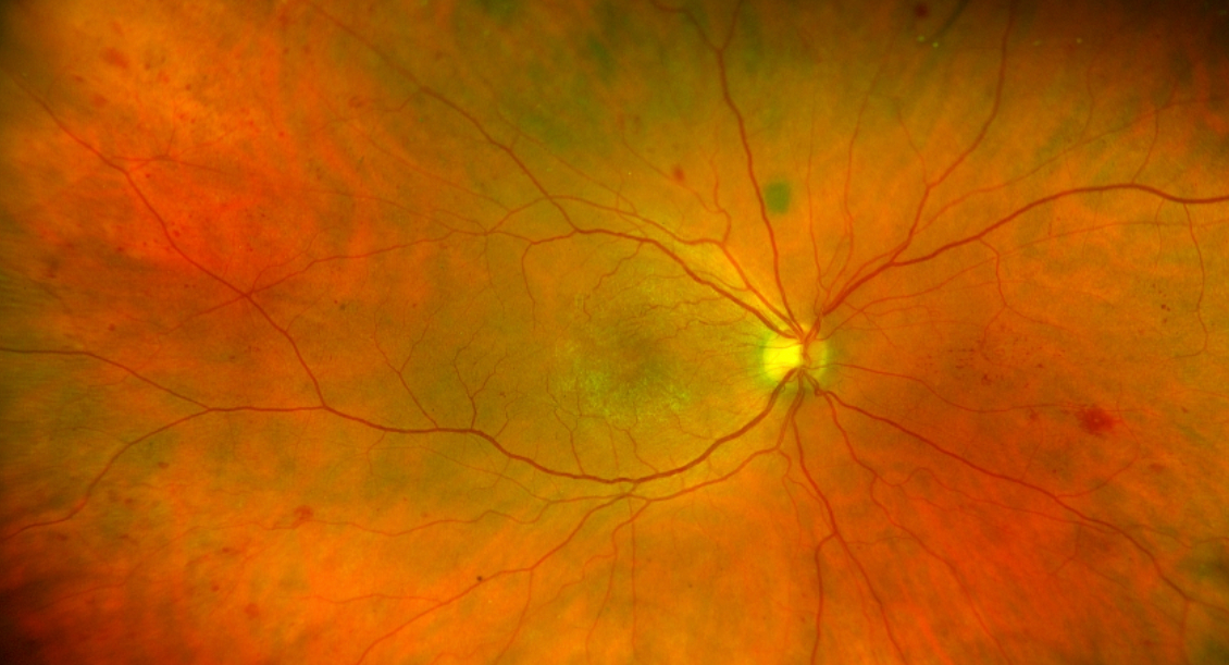 Fundus photography of the patient’s right eye, with signs of retinal hemorrhages.