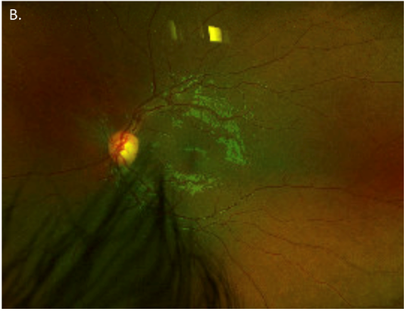 Myelinated retinal nerve
