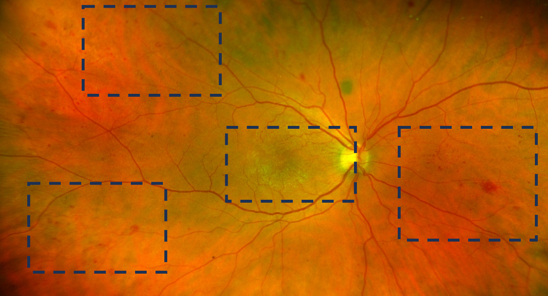 Fundus photography of the patient’s right eye (and the quadrants highlighted by Dr. Attar as areas of concern).