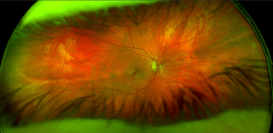 Retinal emboli UW fundus