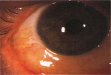 https://covalentcareers3.s3.amazonaws.com/media/original_images/allergic-conjunctivitis-red-eye.png