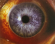 https://covalentcareers3.s3.amazonaws.com/media/original_images/subconjunctival-hemorrhage-red-eye.png